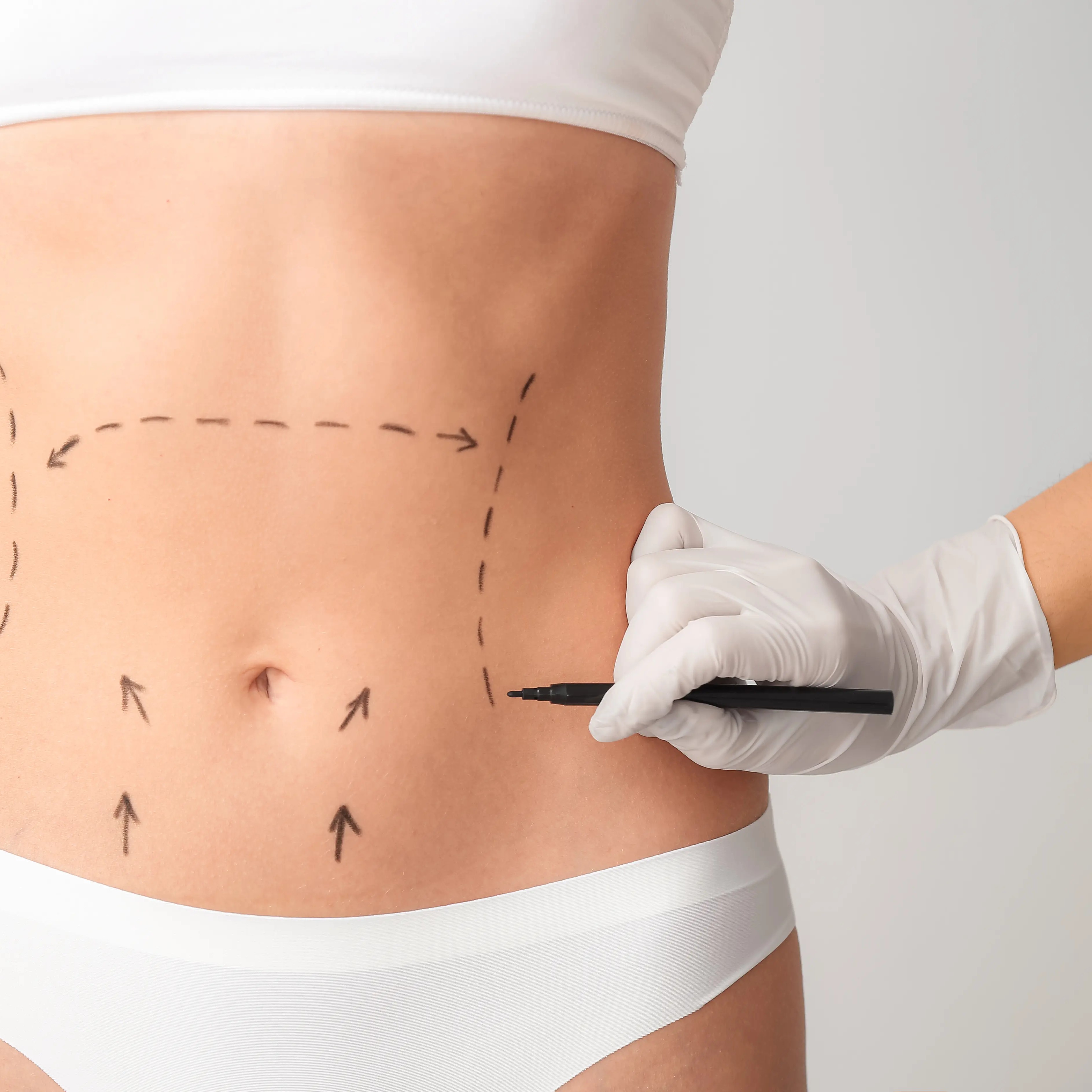 Abdominoplasty