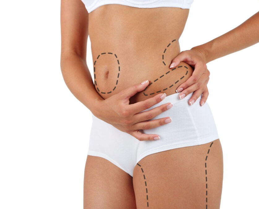 Liposuction